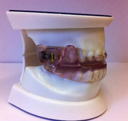 Custom Mouth Guard - Teeth Grinding